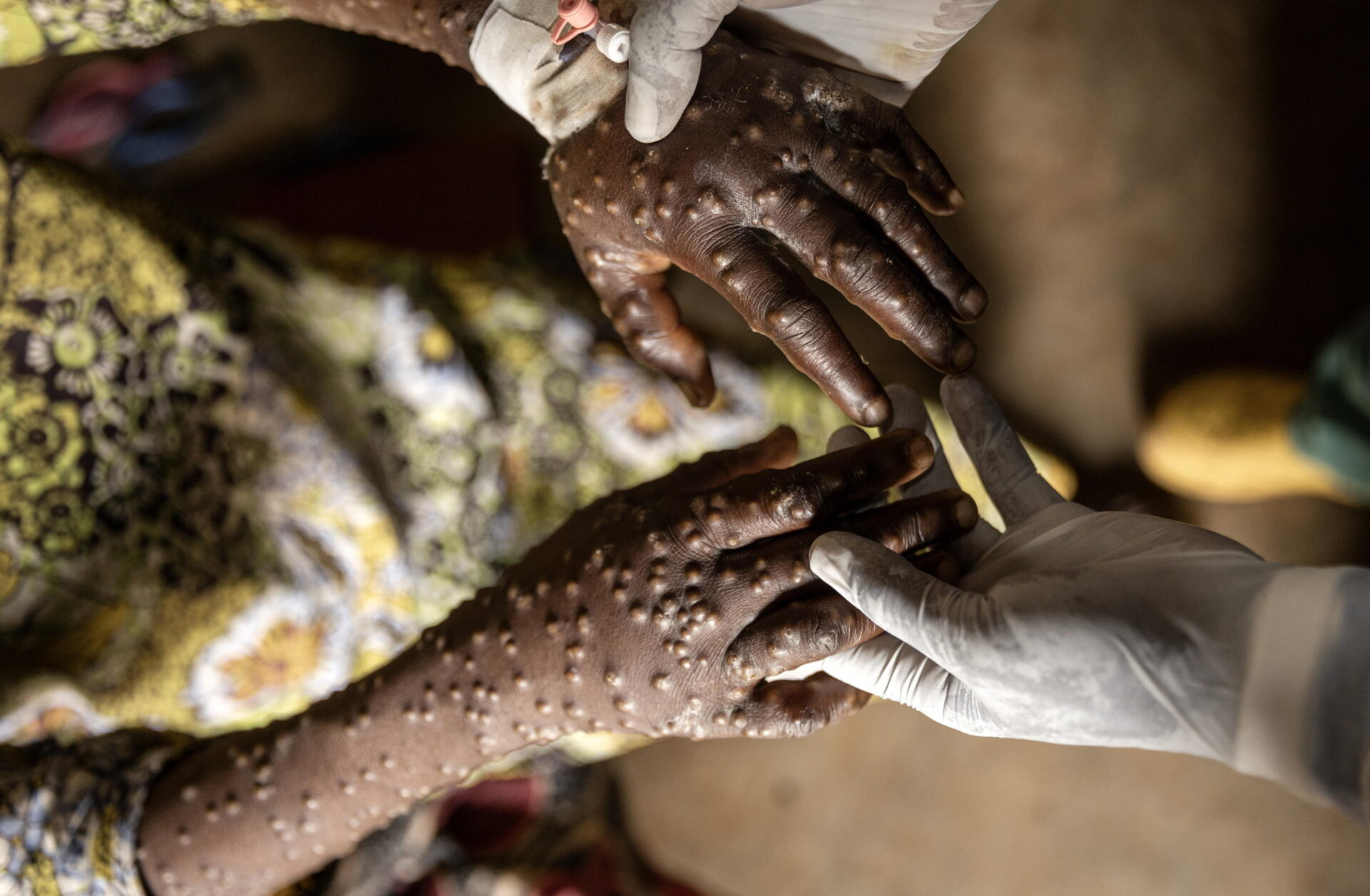 mpox e crisi africana il ritorno di un8217epidemia dimenticata